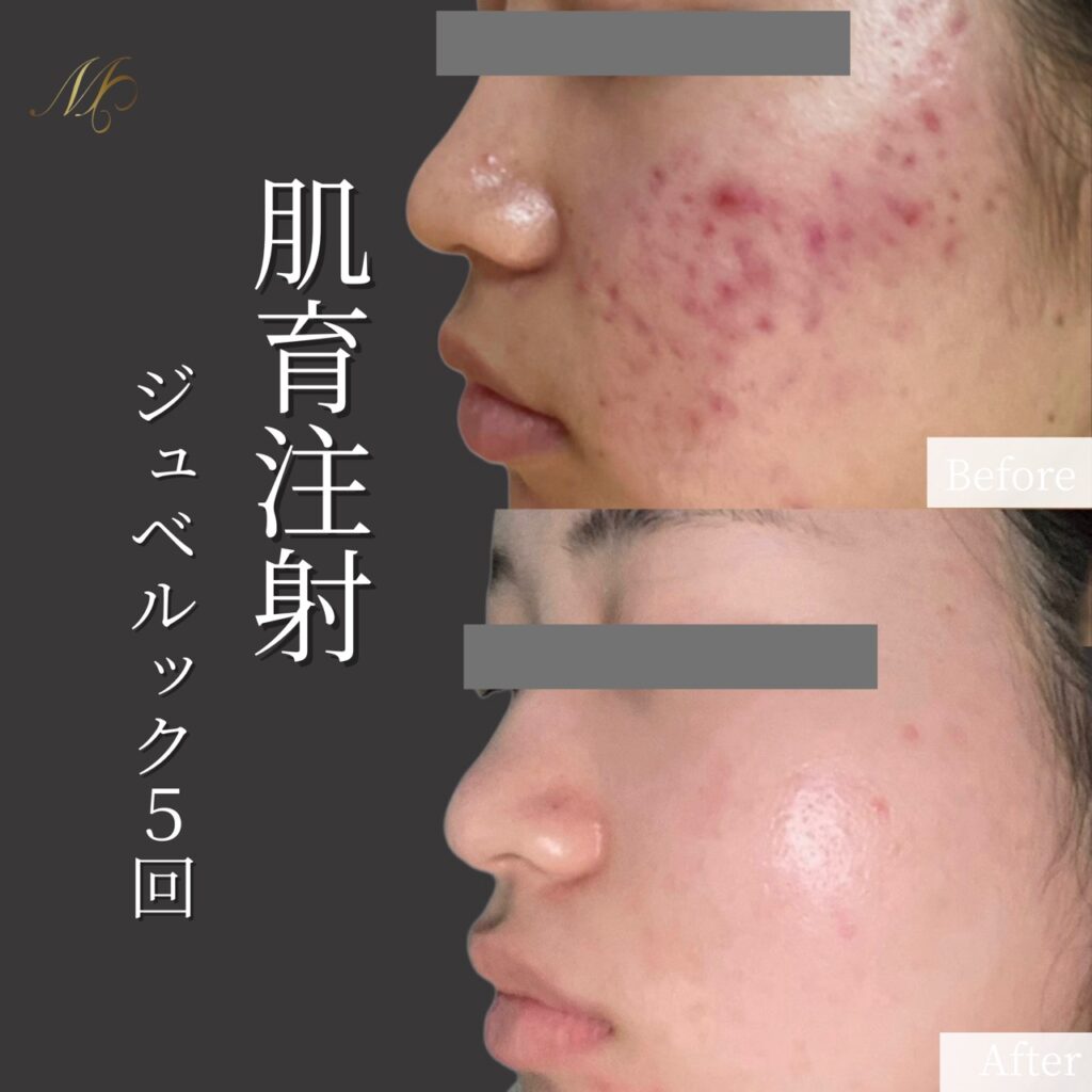 ジュベルック5回（肌育注射）