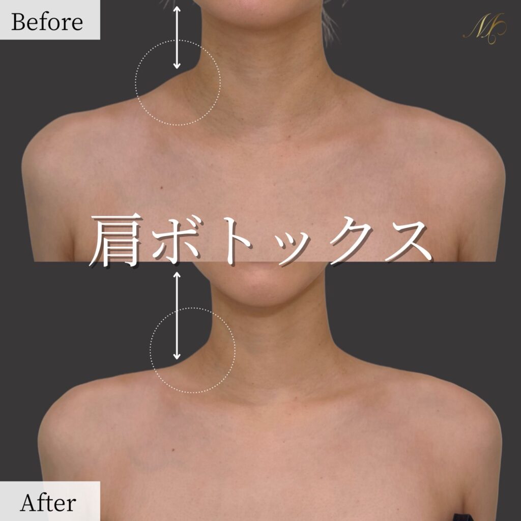 肩ボトックス